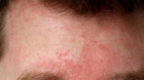 Eksem – symptom, råd och behandling .